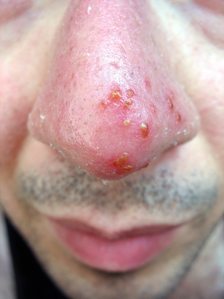 a-medical-condition-closeup-of-the-common-coldsore-virus-herpes-simplex