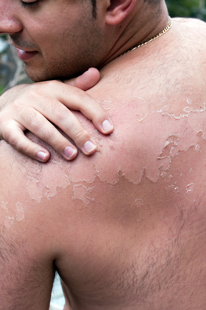 Close up detail of a very bad sunburn showing the peeling blistered skin of a mans back. Shallow depth of field.