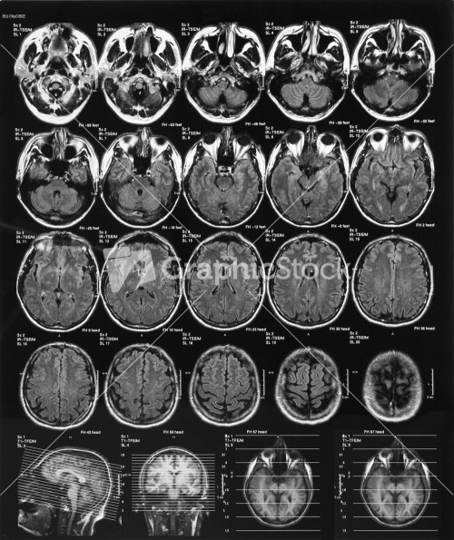 X-ray Film Of The Brain Computed Tomography